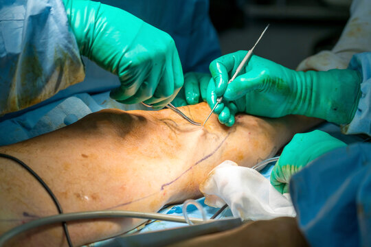 Process of varicose vein surgery in hospital, vein sealing, venous vascular surgery, phlebectomy surgery, surgical field marking, superficial veins problems, swollen skin, step by step