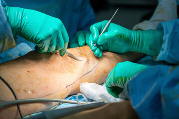 Process of varicose vein surgery in hospital, vein sealing, venous vascular surgery, phlebectomy surgery, surgical field marking, superficial veins problems, swollen skin, step by step