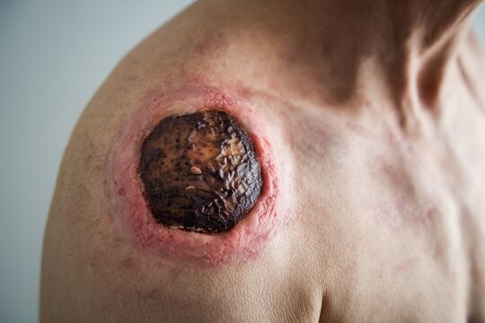 Close-up Image of a Severe Skin Wound on a Person's Shoulder