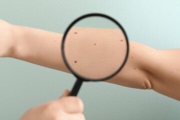 Dermatologist with magnifier examining moles on woman's arm against green background, closeup