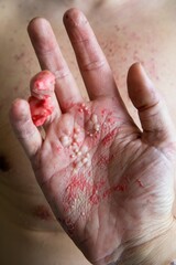Close-up Image of a Hand with Severe Skin Condition
