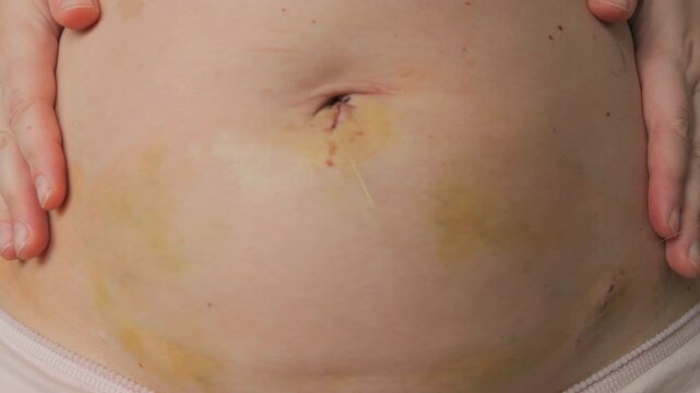 Close Up of a Womans Abdomen After Laparoscopy with Stitches Still in Place