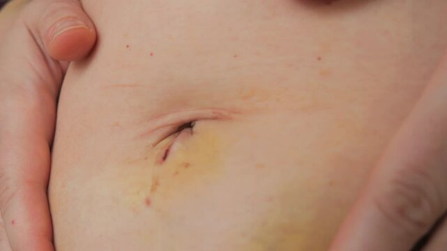 Close Up of a Womans Abdomen After Laparoscopy with Stitches Still in Place