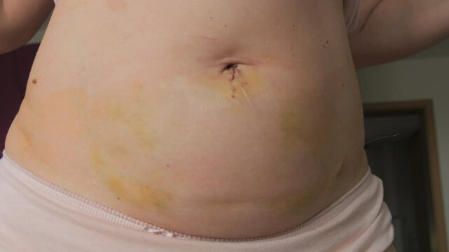Close Up of a Womans Abdomen After Laparoscopy with Stitches Still in Place