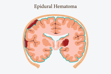 Neurology infographic depicting different types of traumatic brain injuries.