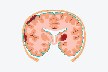 Educational brain anatomy chart showing hematoma locations and hemorrhage classifications.