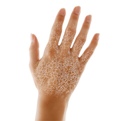 Hand Skin Condition Dryness, Flaking, Bubbles, Irritation, Eczema, Treatment, Remedy, Relief, Care, 