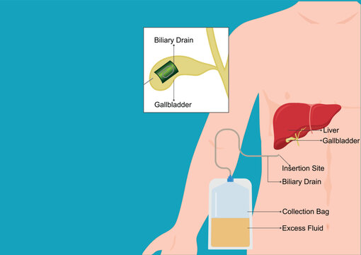 A biliary drain allows bile.