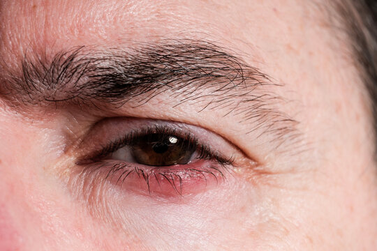 Man suffering from blepharitis showing red and inflamed eyelid