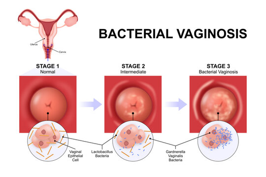 Bacterial vaginosis (BV) vaginal infection illustration