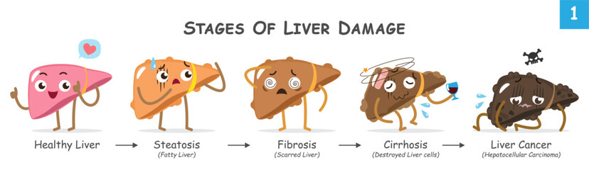 Stages of liver damage . Collection of cute medical cartoon characters about progression of liver disease . Vector . © stockdevil