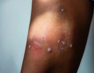 Fototapeta premium Blistering skin after an allergy test on a forearm, showcasing body reactions to allergens.