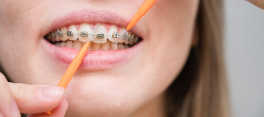 Unrecognizable Caucasian woman cleans braces with a brush. Close-up of female teeth with brackets