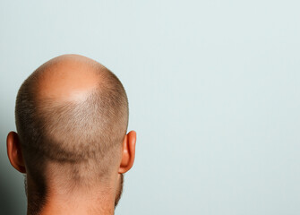 Close up of bald man head showing patches of baldness and hair growth. image captures unique texture and pattern of scalp, evoking sense of individuality