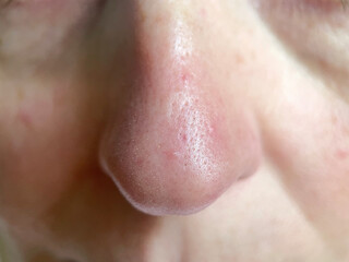 Close-up of Nose with Clogged Pores, Visible Blackheads and Whiteheads – Skin Imperfections and...