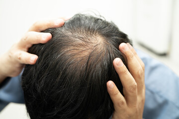 Fototapeta premium Bald in the middle head and begin no loss hair glabrous of mature Asian business smart active office man.