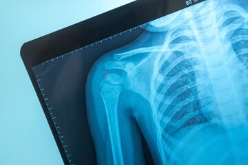 Chest X-ray photo image of a child on blue background