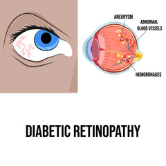 Obraz premium Diabetic retinopathy, an eye disease that damages the blood vessels of the retina.