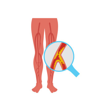 Peripheral Artery Disease, Cardiovascular Disease Illustration Icon