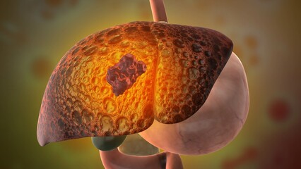 Hepatocellular Carcinoma Liver Tumor Medical Concept