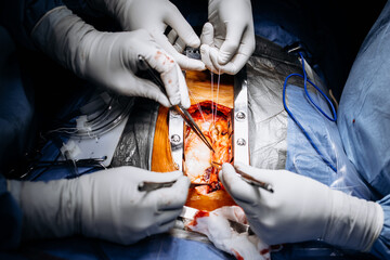 Close-up of a heart surgery in a modern operating room. The concept of precision and high-tech...