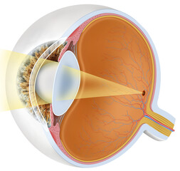 Illustration of the normal visual focus of the eye. This allows us to see, forming the image directly on the retina, thanks to the correct curvature of the cornea and the lens.
