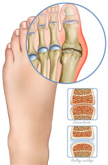 Illustration of a foot with osteoarthritis, a degenerative disease that affects the joints, causing pain, stiffness, and wear of the cartilage, limiting movement.
