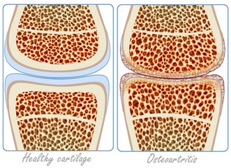 Diagram of osteoarthritis, a degenerative disease that affects the joints, causing pain, stiffness, and wear of the cartilage, limiting movement.