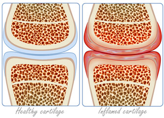 A diagram illustrating inflammation in the joint caused by rheumatoid arthritis can be seen and compared with half of the image of a healthy joint.