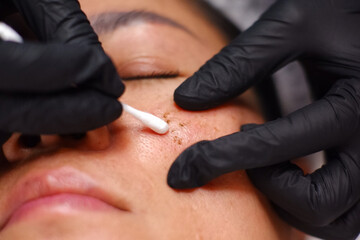 Fototapeta premium Freckles, laser plasma removal