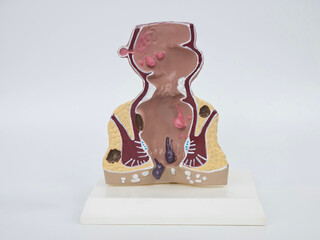 Model of unhealthy lower rectum with inflamed vascular structures. Problem of hemorrhoids and...
