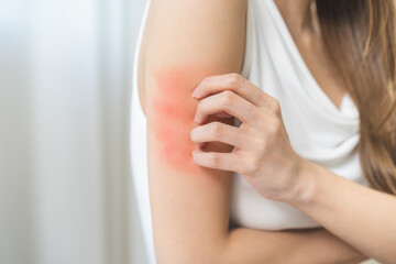 Dermatology asian young woman, girl allergy, allergic reaction from atopic, insect bites on her arm, hand in scratching itchy, itch red spot or rash of skin. Healthcare, treatment of beauty.