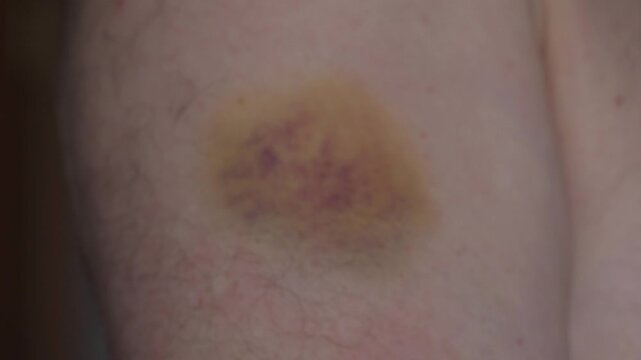close-up hematoma large bruise on a man's arm, consequences of a fight or traces of beatings