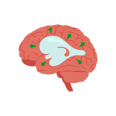 Hydrocephalus, Disability Vector Illustration Isolated