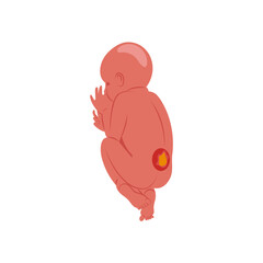 Spina, Bifida, Disability Vector Illustration Isolated