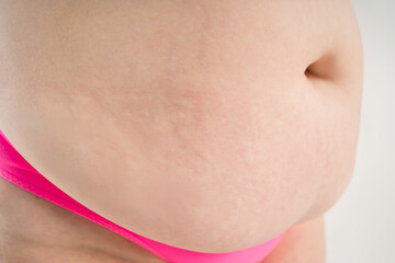 Tummy tuck, flabby skin with stretch marks on a fat belly, plastic surgery concept on gray background
