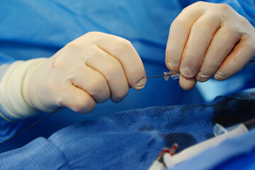 Surgeon's hands during surgery on blood vessels in close-up. Removal of blood clots. Prevention of...