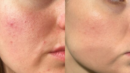 Before and After Skin Transformation: Close-Up of Acne-Prone, Pore-Visible, and Wrinkled Face...