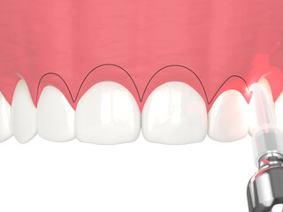 3d render of upper jaw treated with laser for gummy smile. Creating a new gum line by gingivectomy.