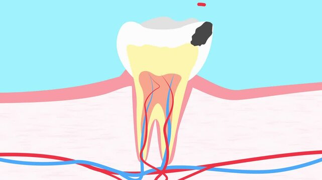 Molar tooth damaged by caries. Medically accurate tooth 2D animation. Tooth damaged by caries
