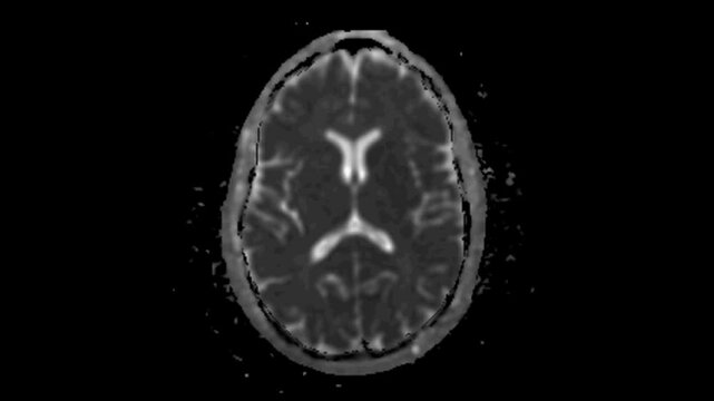 MRI examination of the brain. Apparent diffusion coefficient (ADC) MRI images of the brain. Series description: ADC (10^-6mm/s).