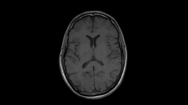 MRI examination of the brain. Axial T1-weighted SE (spin echo) images of the brain.