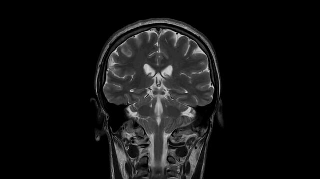 T2-weighted coronal plane fast spin echo MRI of the brain. Series description: Cor T2 FSE. Enlarged perivascular spaces are registered in the supratentorial white matter.