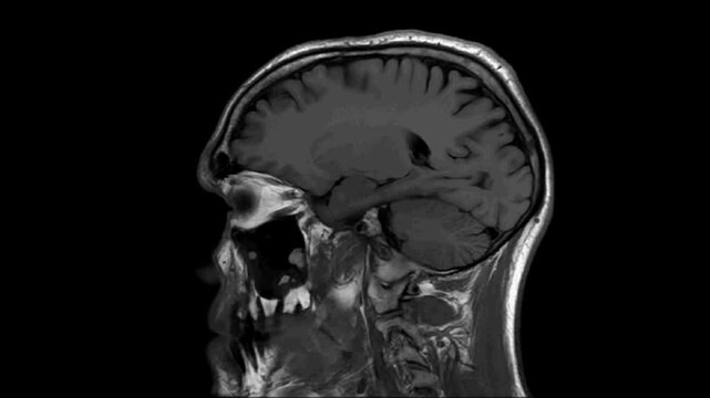 MRI examination of the brain. Sagittal plane. T1-weighted fluid-attenuated inversion recovery pulse sequence. Series description: Sag T1 FLAIR.
