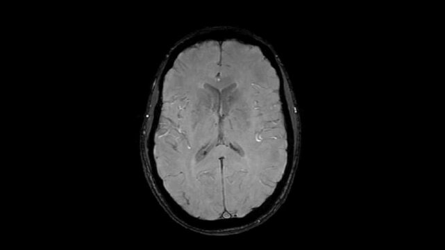 MRI examination of the brain. Axial plane. Series description: 3D Ax SWAN. Findings show no significant pathological changes.