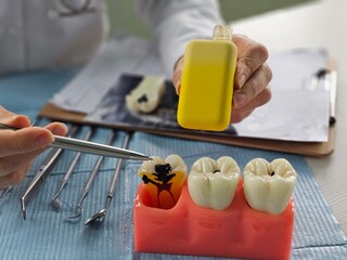 Jaw model with electronic vaping device. Vaping causes tooth decay
