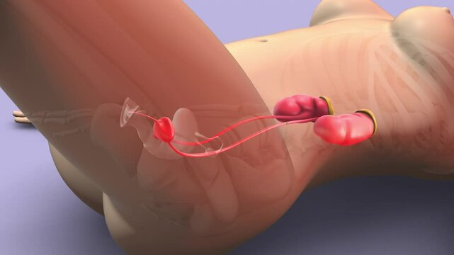 Ureteroscopy and laser lithotripsy for renal stones