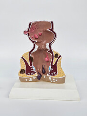 Model of unhealthy lower rectum with inflamed vascular structures. Problem of hemorrhoids and...