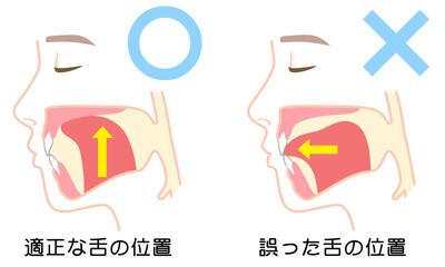 正しいミューイングの方法　適正な舌の位置と誤った舌の位置