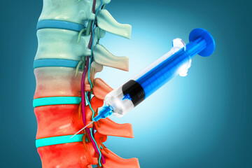 Human spinal cord injury, lumbar spine injection. 3d illustration